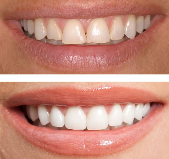 Teeth Whitening